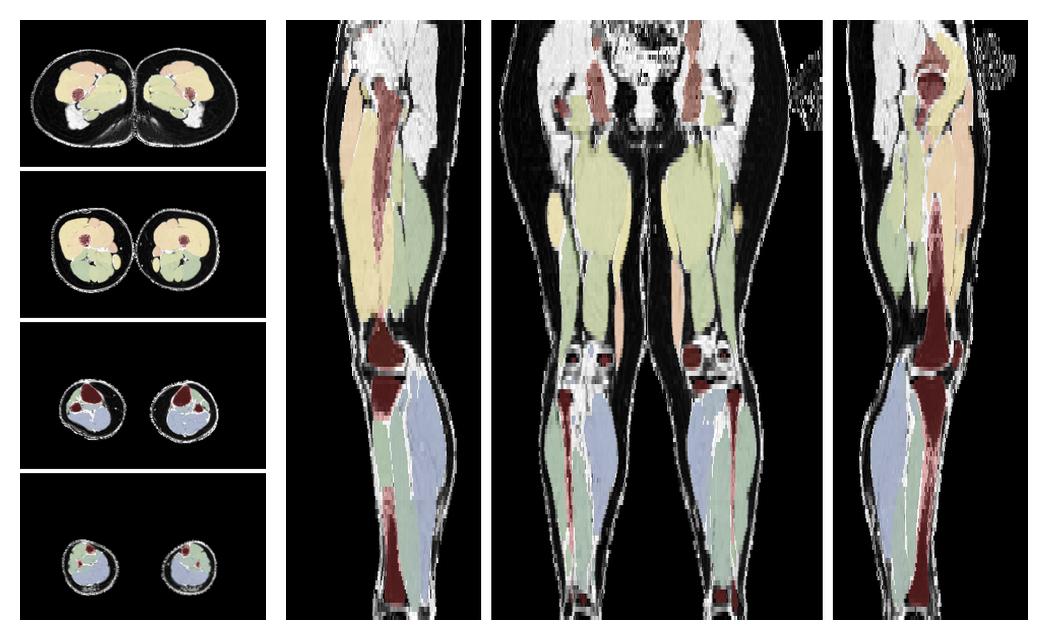 Overlay of automated muscle segmentation labels on dixon water image.